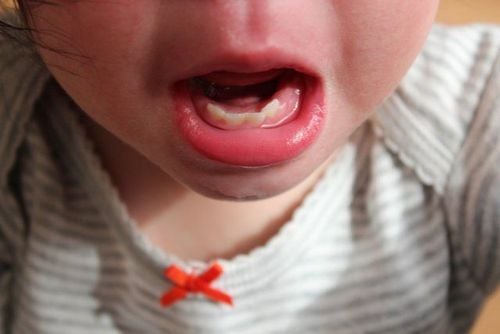 Trẻ bị sưng nướu răng biểu hiện bệnh gì?