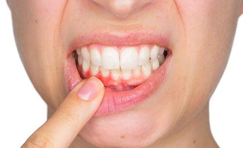 Bị chảy máu khi đánh răng là bệnh lý gì?
