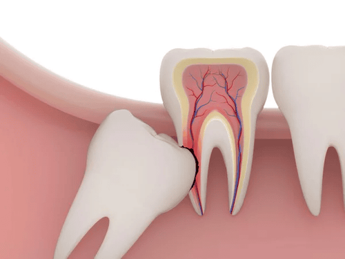 
Răng khôn mọc lệch gây ảnh hưởng đến các răng bên cạnh
