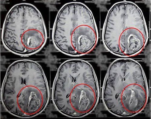 
Chụp MRI giúp phát hiện khối u trong não bệnh nhân
