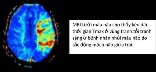 Chụp cộng hưởng từ tưới máu não (MRI perfusion) - P1