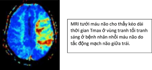 Brain perfusion magnetic resonance imaging (MRI perfusion) - P1