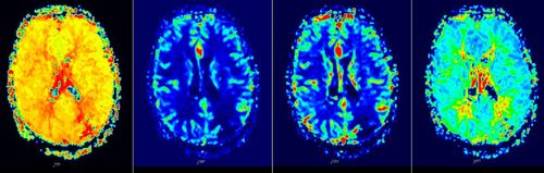 Brain perfusion magnetic resonance imaging (MRI perfusion) - P1