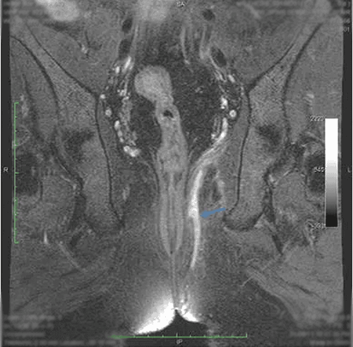 
Coronal T2 SPAIR: đường rò xuyên cơ thắt
