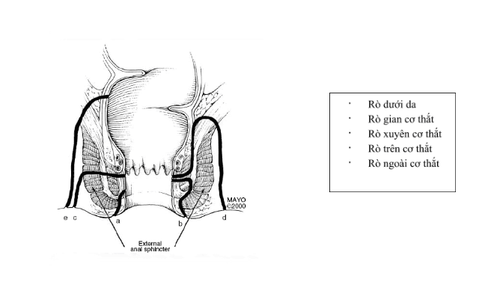 
Bệnh lý rò hậu môn cần được phát hiện và xử lý kịp thời
