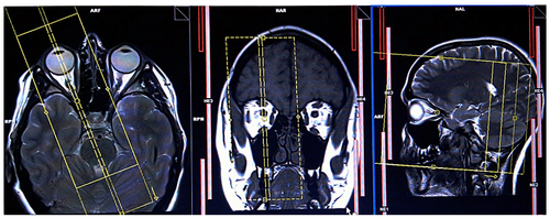 Magnetic resonance imaging of the orbit and optic nerve