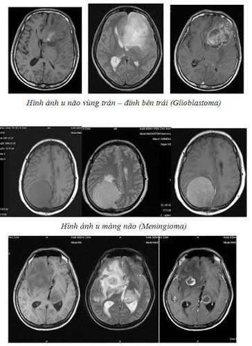 
Chụp MRi giúp đưa ra chẩn đoán chính xác về tình trạng bệnh
