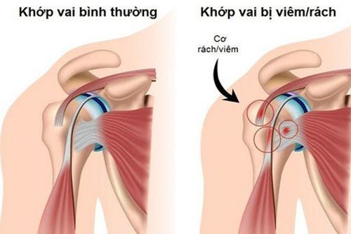 Các bài tập phục hồi chức năng viêm quanh khớp vai