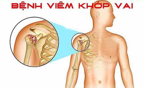 
Có nhiều nguyên nhân gây ra viêm quanh khớp vai
