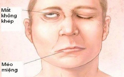 Treatment of peripheral nerve VII paralysis with physical therapy