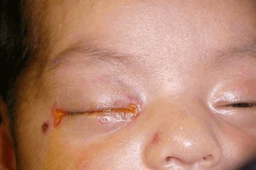 Mắt trẻ sơ sinh có nhiều gỉ kèm theo chảy nước vàng có làm sao không?