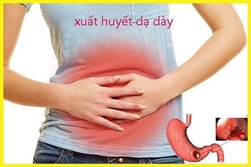 
Xuất huyết dạ dày do tác dụng phụ của thuốc methylprednisolone
