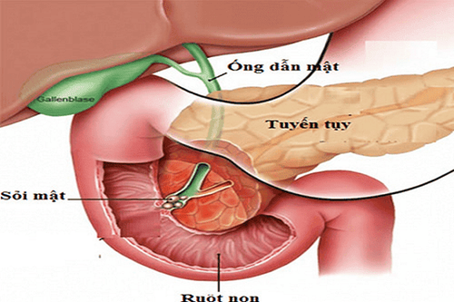 
. Thủ thuật ERCP có thể gây viêm tụy cấp
