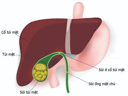 Trẻ 2 tuổi mắc bệnh sỏi túi mật có nguy hiểm hay không?