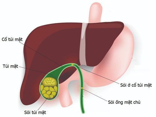 
Cà phê có khả năng làm giảm nguy cơ xuất hiện sỏi túi mật
