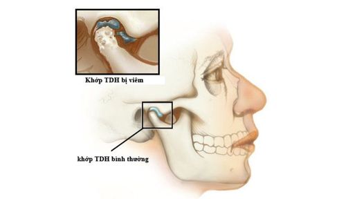 What is temporomandibular pain accompanied by difficulty swallowing and painful swallowing?