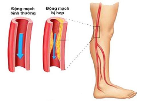 Axillary and femoral artery bypass surgery