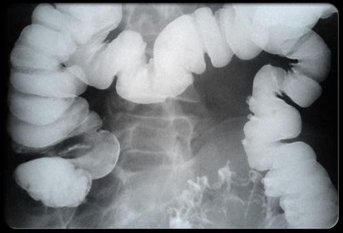 Colon X-ray in the diagnosis of cancer