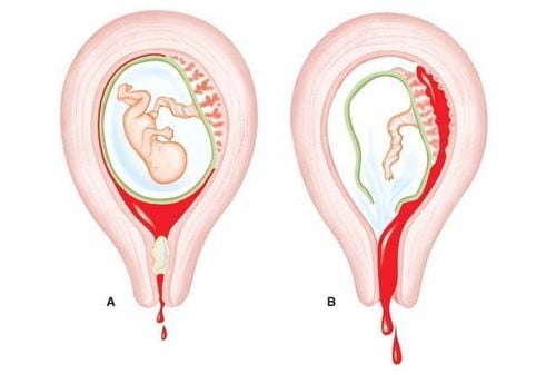 Ra máu khi mang thai 5 tuần phải làm gì?