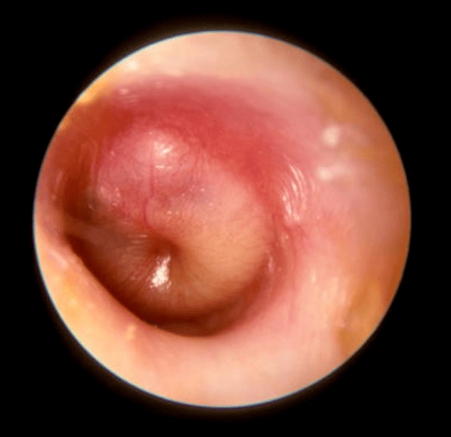 
Endoscopic images help doctors evaluate damage in the ear canal
