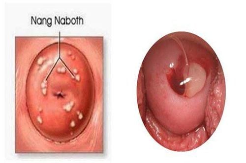 
Nang naboth thường có màu vàng hay màu trắng, mặt nhẵn nhụi
