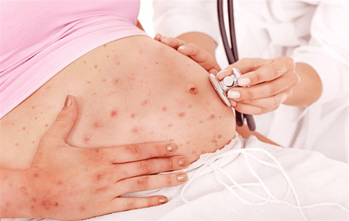 Chickenpox in pregnant women and congenital varicella syndrome