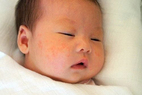 Trẻ mới sinh nổi mẩn đỏ liên tục có nguy hiểm không?