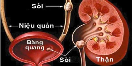 Tán sỏi niệu quản nên dùng gây mê hay gây tê?