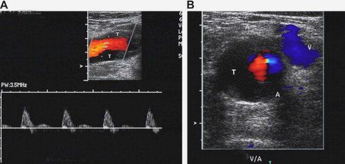 Can Doppler ultrasound of blood vessels detect arteriovenous fistula?