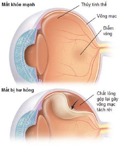 
Rách võng mạc
