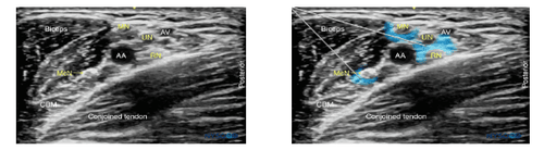 Methods of anesthesia of the brachial plexus