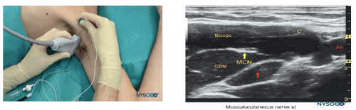 Methods of anesthesia of the brachial plexus