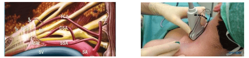 Methods of anesthesia of the brachial plexus