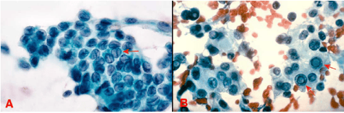 
Hình 5: Carcinôm tuyến giáp dạng nhú, tế bào có nhân lớn hình bầu dục, lợt mầu, chồng chất lên nhau và có rãnh (mũi tên) (A); một số nhân có thể vùi (mũi tên) (B).
