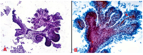 
Hình 4: Carcinôm tuyến giáp dạng nhú, tế bào u tạo thành nhú 1 lớp 2 chiều (A); hoặc nhú 3 chiều có trục liên kết mạch máu (mũi tên) (B).
