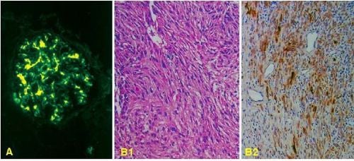 
Hình 4: Hoá mô miễn dịch huỳnh quang, dùng kháng thể huỳnh quang chống IgA cho thấy có sự lắng đọng của IgA ở vùng giãn mao mạch trong bệnh thận IgA (A). Một u kém biệt hoá cấu tạo bởi tế bào hình thoi trông giống như một sarcoma (B1), nhuộm hóa mô miễn dịch men với kháng thể chống cytokeratin cho thấy tế bào u bắt màu nâu (B2), chứng tỏ đây là một carcinôm chứ không phải là sarcoma.
