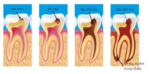 
Sâu răng tiến triển đến nhiễm trùng tại chỗ
