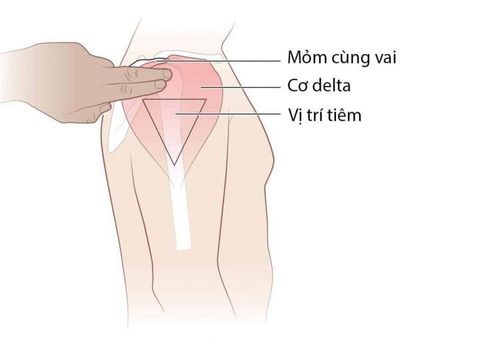 
Một số trường hợp cần tiêm bắt để điều trị viêm mi
