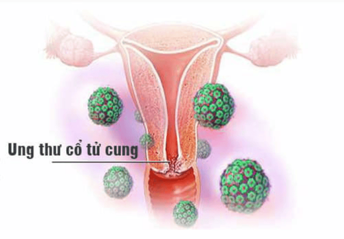 
HPV là một trong những nguyên nhân chính gây ung thư cổ tử cung
