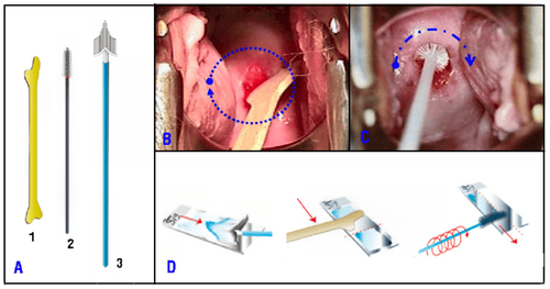 
Hình 1: Que gỗ Ayre (1), que chải (2), chổi quét (3) (A); Dùng que Ayre và que chải để lấy tế bào bong ở vùng chuyển dạng cổ tử cung (B,C); phết tế bào lên lam thành 1 lớp mỏng (D).
