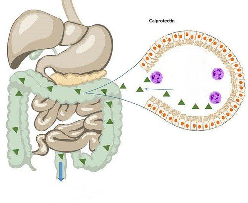 
Một số bệnh lý đường tiêu hóa gây tăng nồng độ Calprotectin trong phân người bệnh
