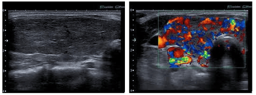 
Hình 2: Tuyến giáp tăng kích thước với nhu mô giảm âm không đồng nhất và tăng tín hiệu mạch trên Doppler màu.
