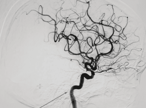 Digital angiography erasing the iliac artery background