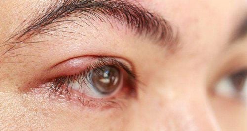 
Bệnh lupus cũng có thể lây lan và phát ban dày lên mí mắt
