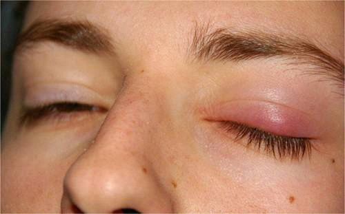 Causes of chafing, stye