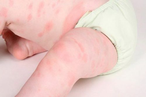 Trẻ 8 tháng tuổi nổi mẩn đỏ kèm sốt là bệnh gì?