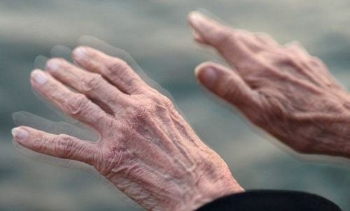 
Dấu hiệu nhận biết của bệnh Parkinson với triệu chứng run tay
