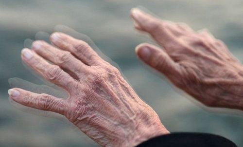 
Parkinson đặc trưng bởi các hội chứng run vô căn
