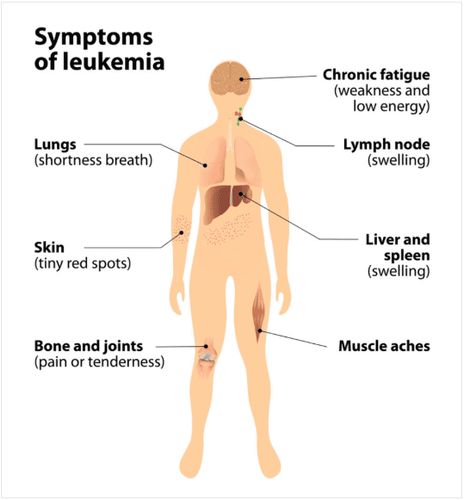 Acute lymphoblastic leukemia