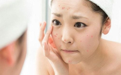 Which skin type is prone to acne?